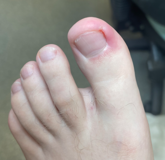 Second toe pain: possible causes - Sport Doctor London